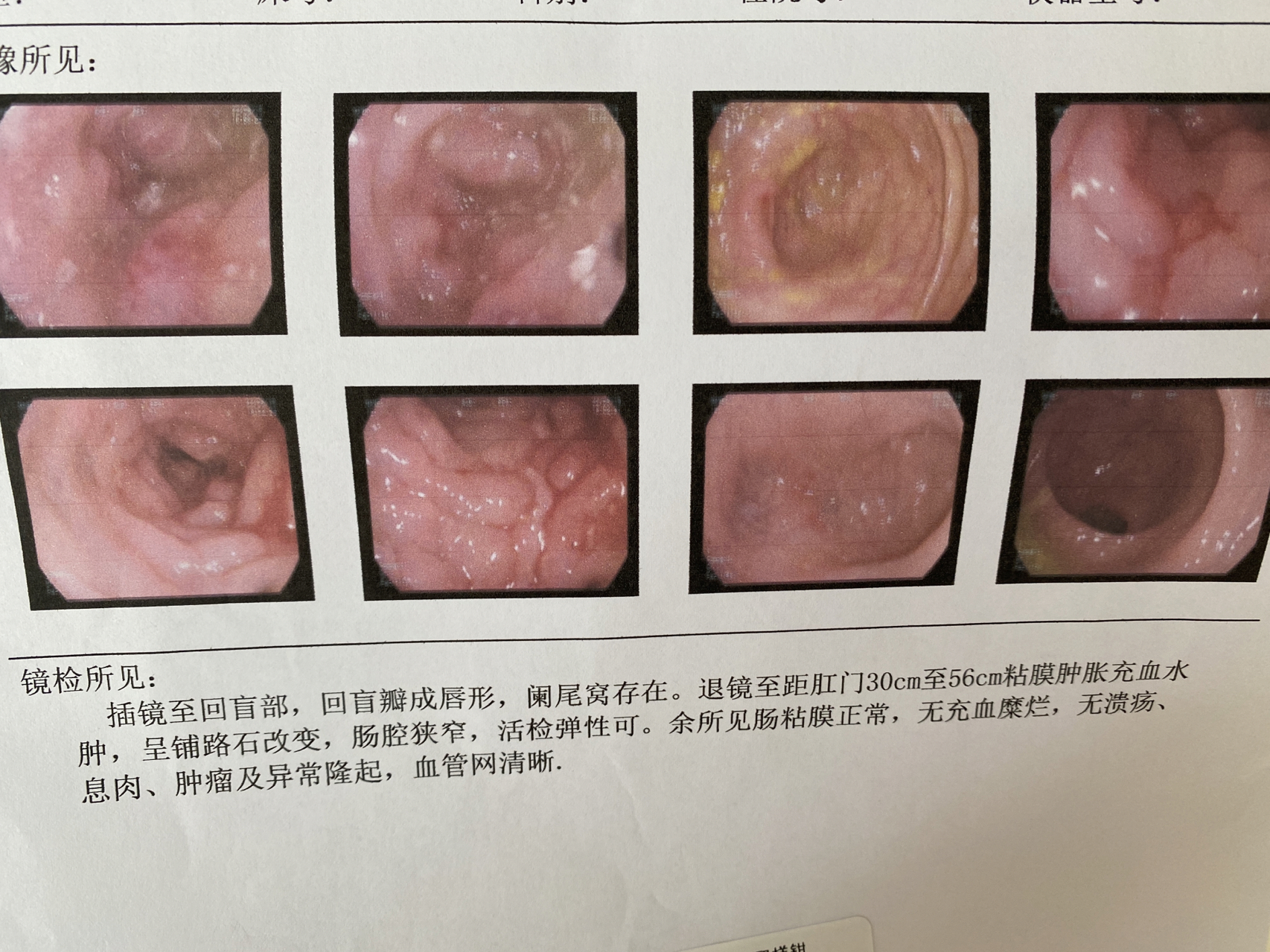 克罗恩最新治疗方法，自然美景的心灵探索之旅